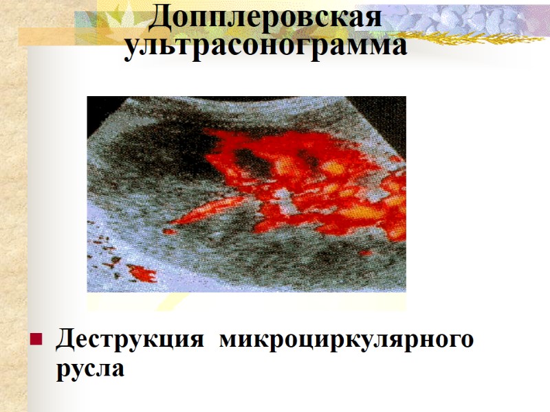 Допплеровская ультрасонограмма Деструкция  микроциркулярного русла